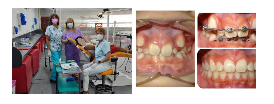 CURSO DE ORTOPEDIA FUNCIONAL DE LOS MAXILARES Y ORTODONCIA EN DENTICIÓN MIXTA - Dra. Mónica Brangeri, Dra. Elizabeth Carreño y Dra. Mónica Santostéfano.